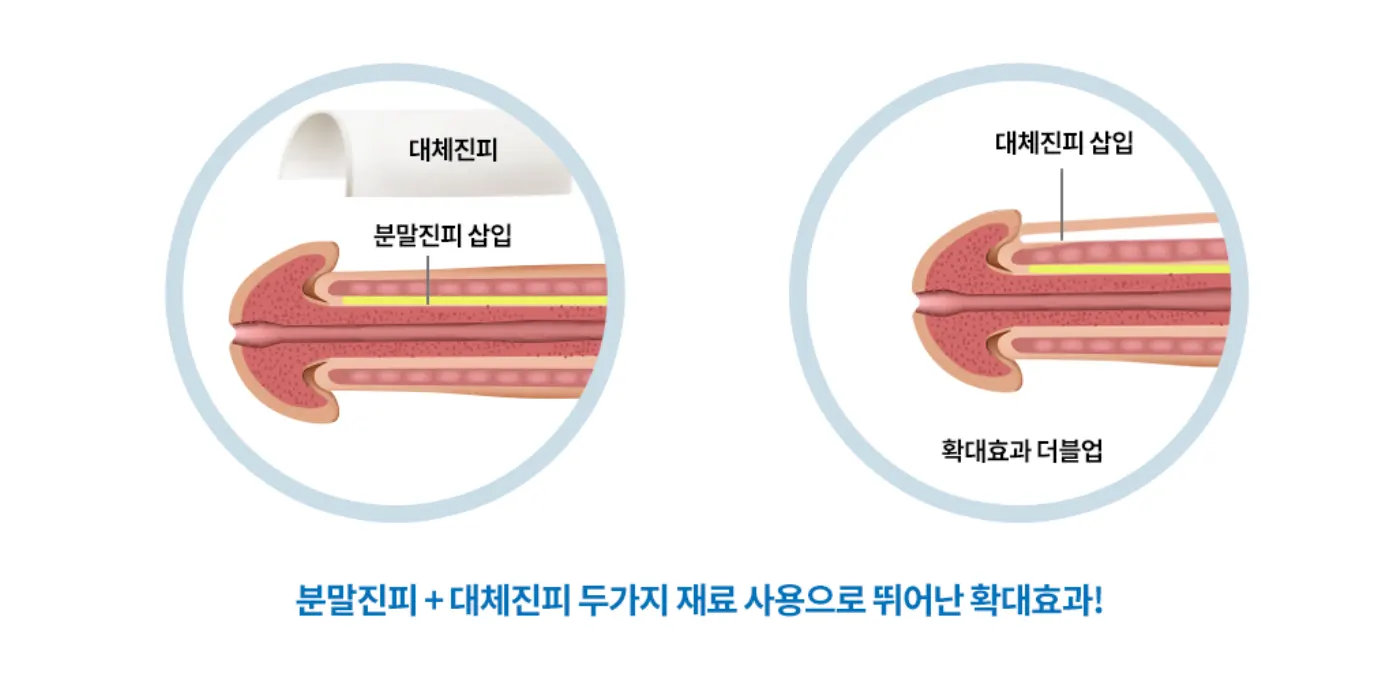분말진피와 대체진피 복합 적용 이미지