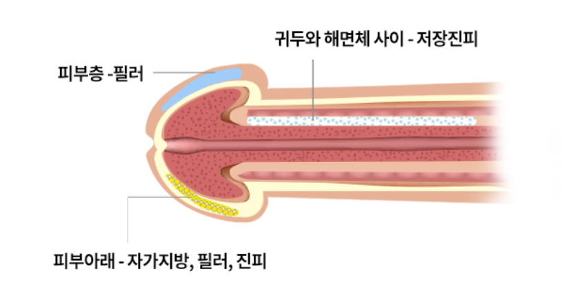 귀두확대 적용 층 참고 도식