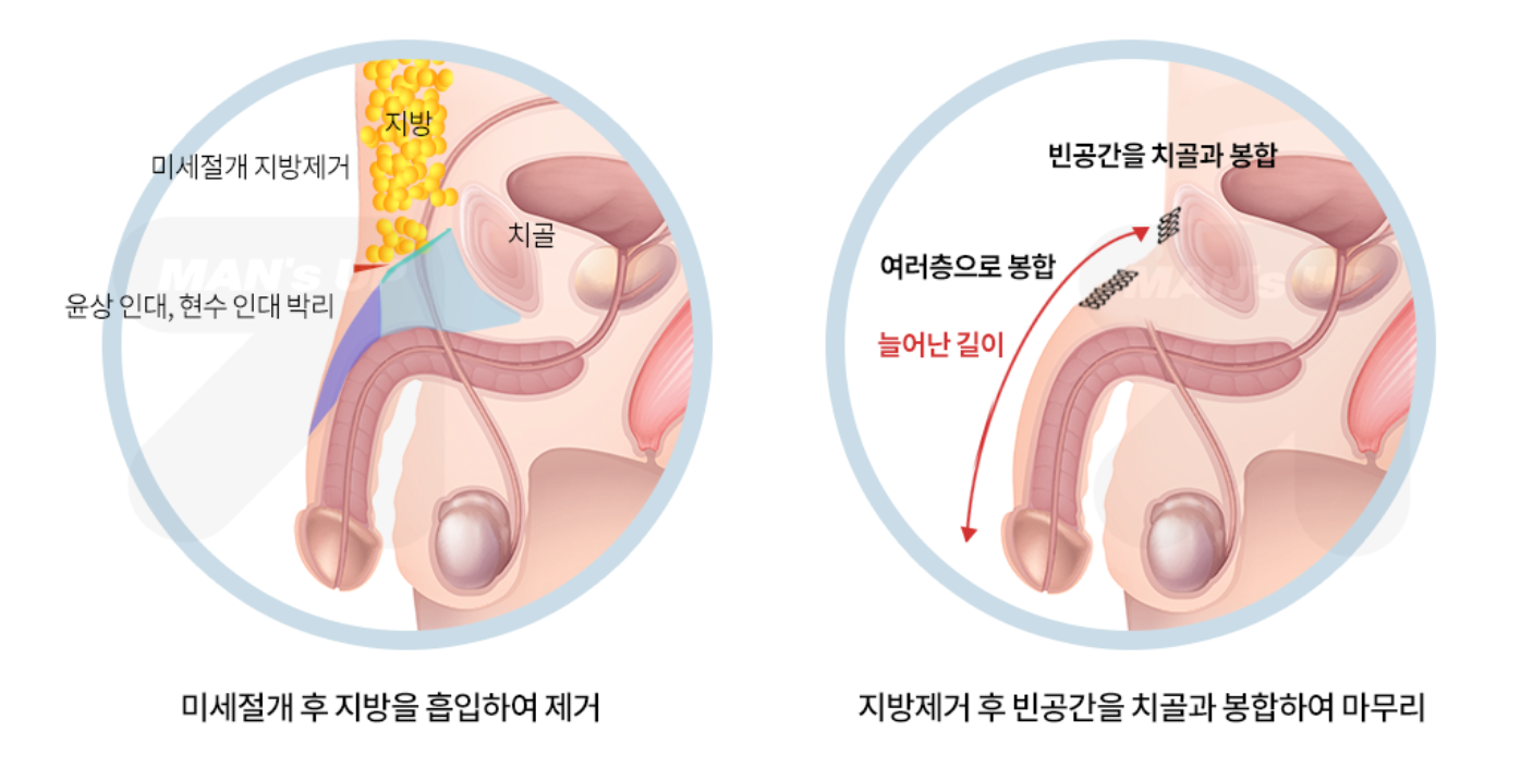 치골부 절개와 지방 교정 참고 도식