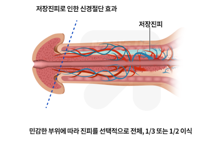 미세신경완화 조루수술 참고 도식