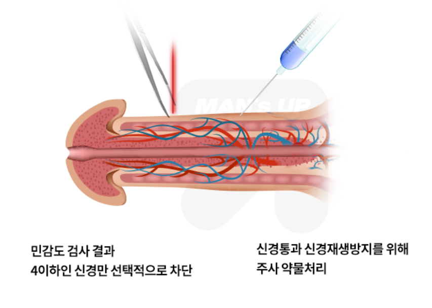 선택적 레이저 신경차단술 참고 도식