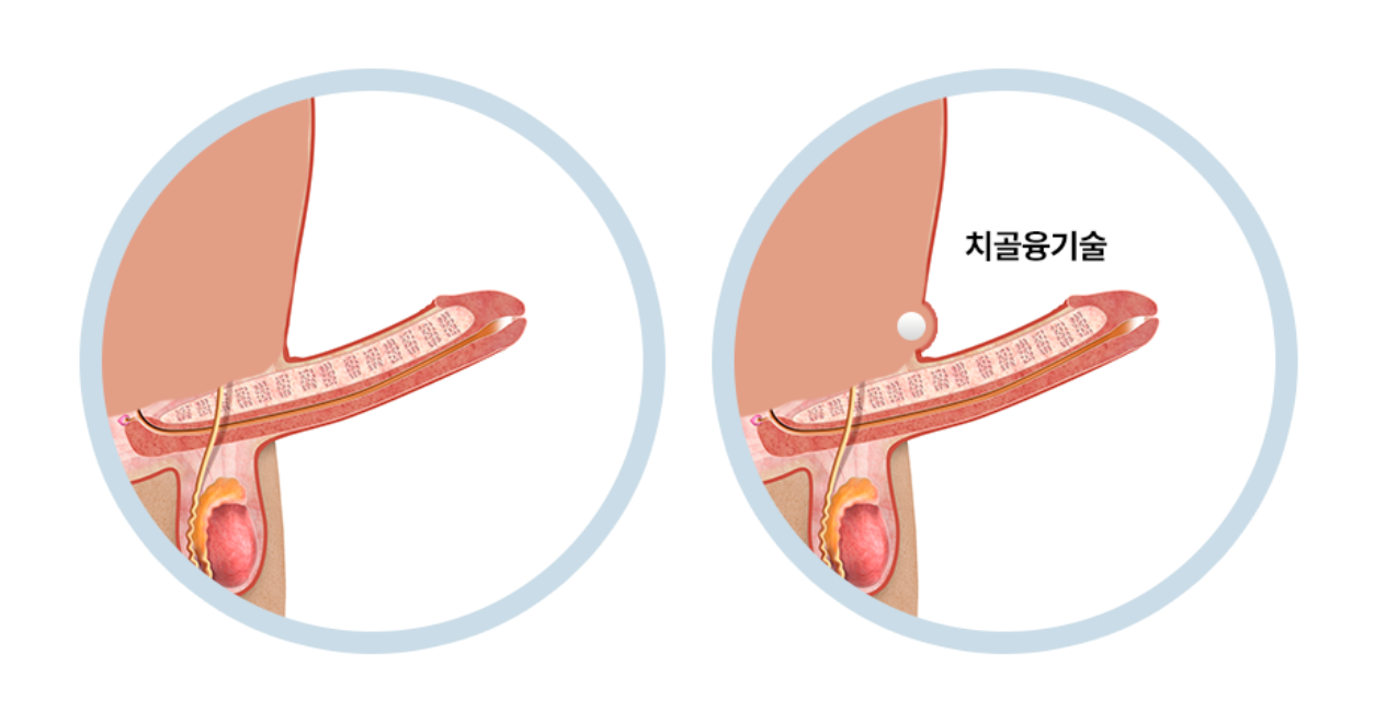 치골융기술 위치 도식