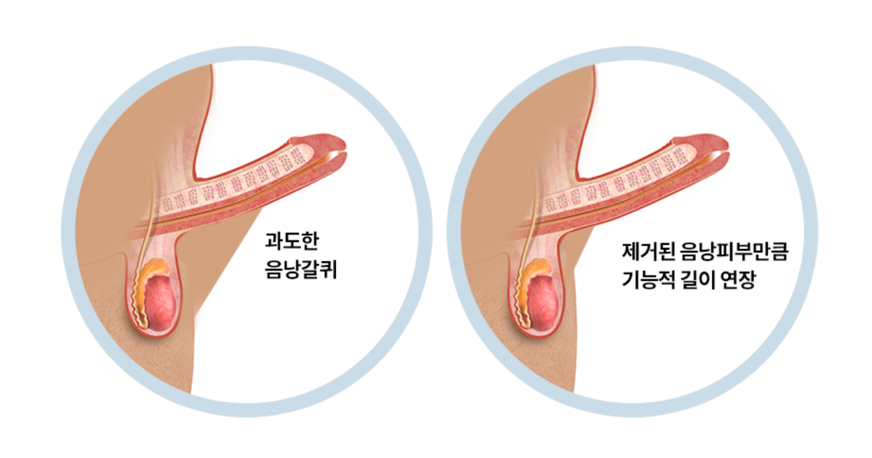 음낭갈퀴성형술 구조 도식