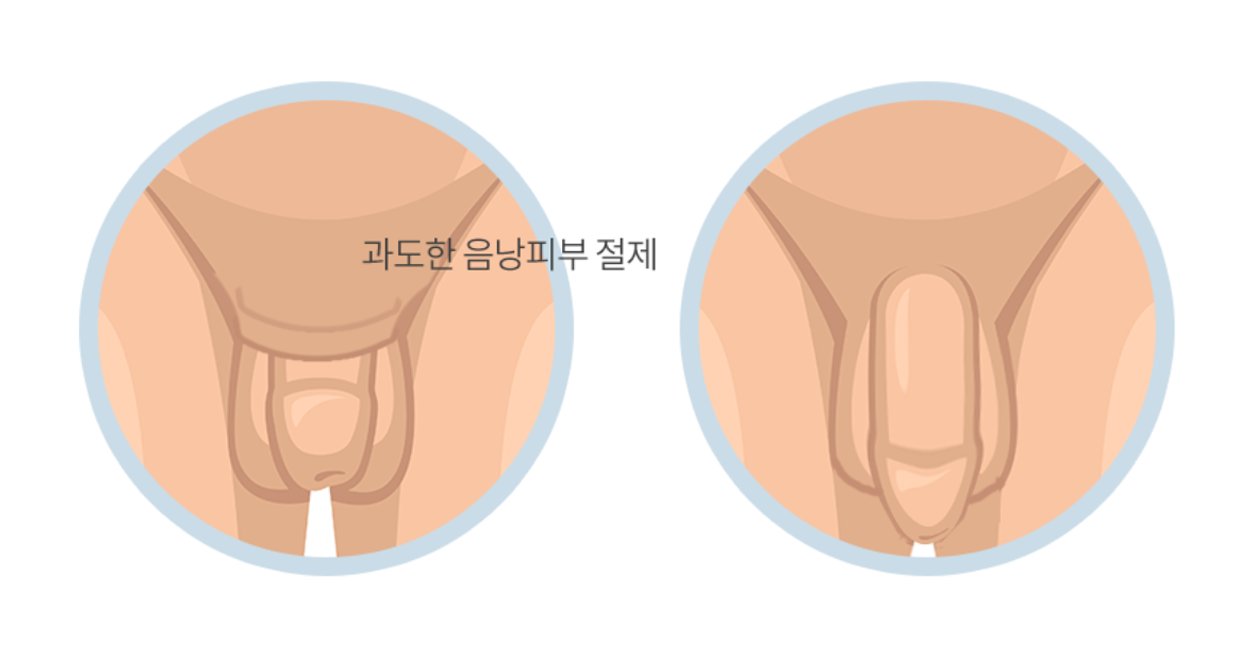 음낭피부성형술 참고 도식